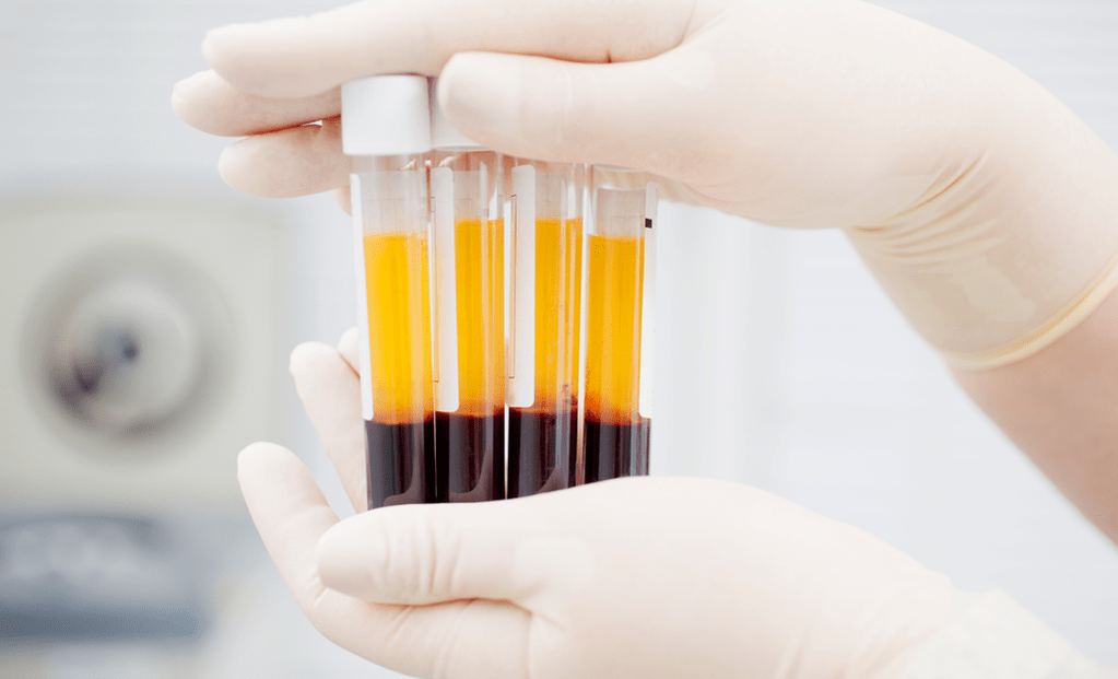 Blóðflöguríkt plasma fyrir PRP meðferð við liðagigt